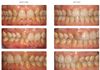 {"blocks":[{"key":"c73ch","text":"Deep bite correction using Incognito lingual braces.  This patient had missing lateral incisors and we used cosmetic bonding to build up the Canines to make them look like Lateral incisors.","type":"unstyled","depth":0,"inlineStyleRanges":[],"entityRanges":[],"data":{}}],"entityMap":{}}