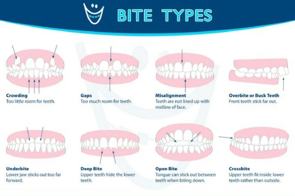 Malocclusions in Bournemouth.  Orthodontics Bournemouth.  orthodontist bournemouth bite resolutions