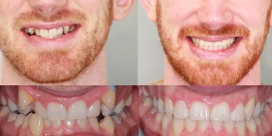 The power of passive self ligation, the power of Damon braces in Bournemouth!

12months treatment, j