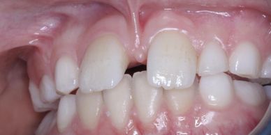 Often Orthodontics in Bournemouth requires a simple surgical procedure called a frenectomy