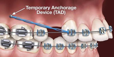 Orthodontic TAD's in Bournemouth.  Used to treat complex, skeletally involved Orthodontic cases 