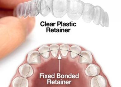 Bonded retainers Bournemouth.  Clear removable retainers, essix retainers bournemouth.  vivera 