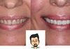 {"blocks":[{"key":"4icno","text":"Smile makeover in Ringwood, the teeth where originally straightened using Invisalign, these were heavily filled teeth, so we decided to place cosmetic porcelain veneers from UR5-UL5","type":"unstyled","depth":0,"inlineStyleRanges":[],"entityRanges":[],"data":{}}],"entityMap":{}}