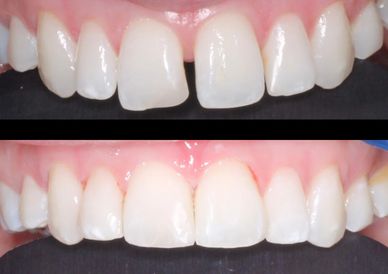 Cosmetic bonding - no need for orthodontics in bournemouth