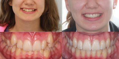 Damon Orthodontics in Bournemouth.  Non extraction orthodontics in Bournemouth