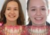 {"blocks":[{"key":"36h6n","text":"A wonderful case.  The patient was refused non extraction Orthodontics from the Nhs Orthodontist.  The extraction treatment plan was scheduled for a 2 year treatment time.  The mother found us and we treated the patient with Damon Q Braces in Ringwood.  Total orthodontic treatment time 10 months! ","type":"unstyled","depth":0,"inlineStyleRanges":[],"entityRanges":[],"data":{}}],"entityMap":{}}