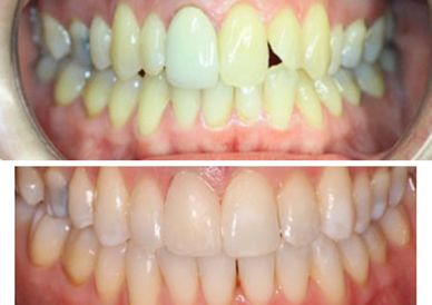 After Invisalign an old crown was replaced for a new same day cerec crown (on the same day).  