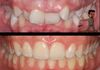 {"blocks":[{"key":"adtfn","text":"Mic drop!  Severe crowding, this patient looked for orthodontics in bournemouth and chose to have Damon Q braces.  With very little if any discomfort this alignment was achieved within 18 months.","type":"unstyled","depth":0,"inlineStyleRanges":[],"entityRanges":[],"data":{}}],"entityMap":{}}