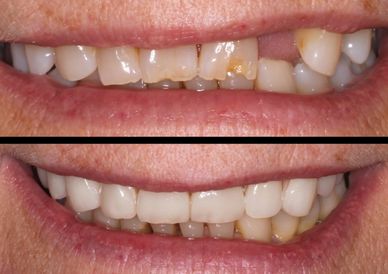 veneers and valplast denture