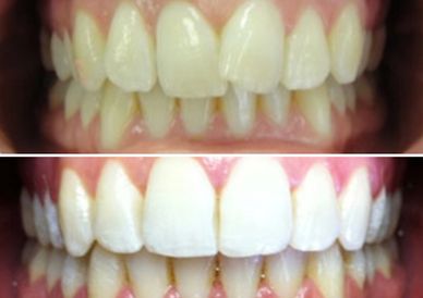 All Orthodontic treatments come with complimentary teeth whitening (RRP £300!)