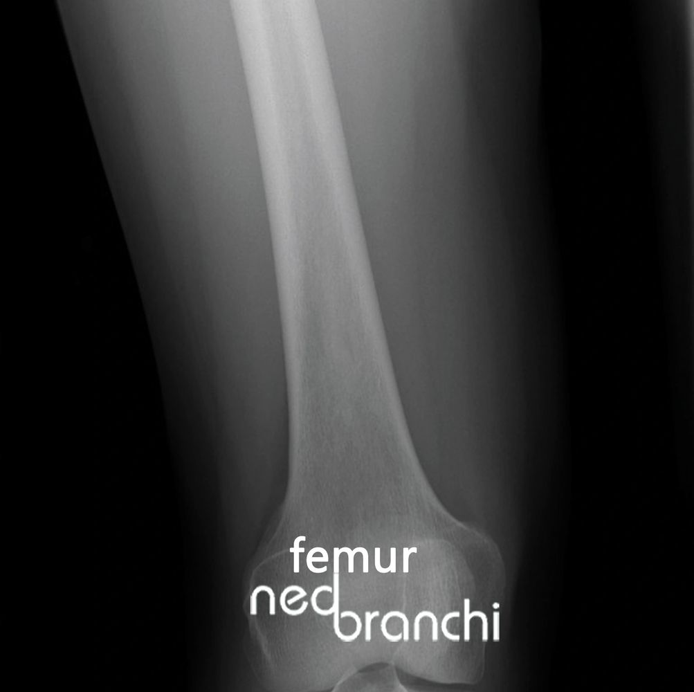 X-ray image showing the lower part of a femur bone.
