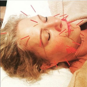 Cosmetic Acupuncture facial rejuvenation client (shared with permission).