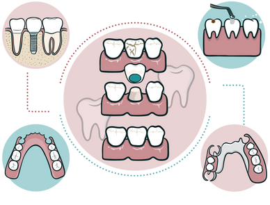 Dental implant. Dental crown. Removable dentures. Dental filling.