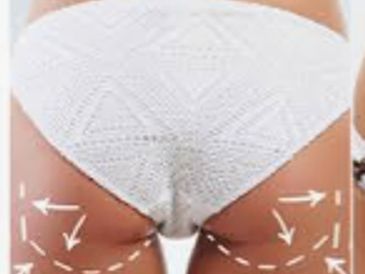 Arrows on lower body marking areas for cosmetic or medical treatment.