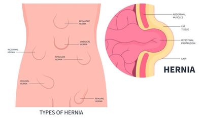 Educational picture showing location of different types of hernias.