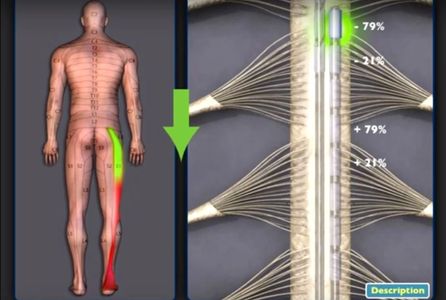 Spinal Cord Stimulation San Jose San Mateo