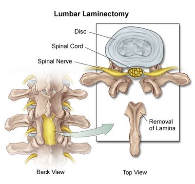 laminectomy