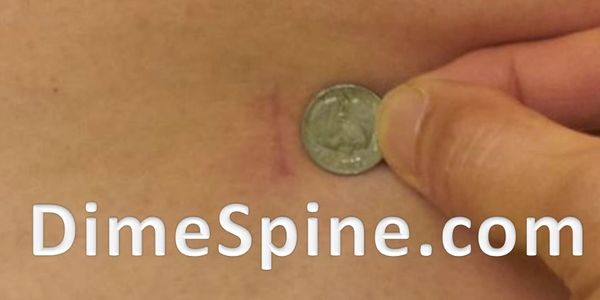 Dime sized incision lumbar fusion