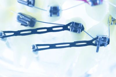 Temporary Anchorage Devices (TADs / Micro Implants)