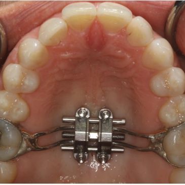 Maxillary Skeletal Expander (MSE)