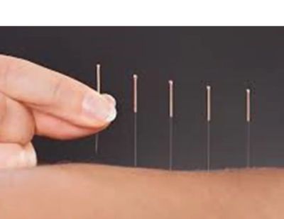 Acupuncture
