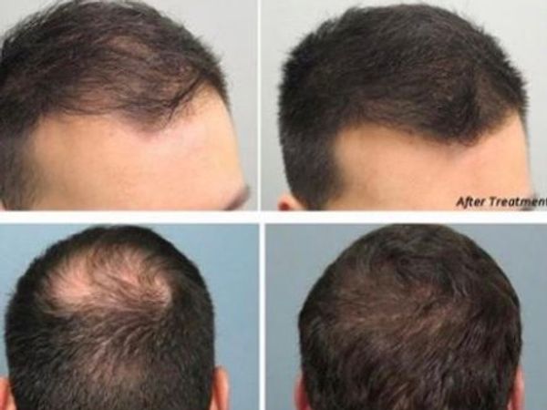 Laser Hair Growth - worldclassbarbers.com