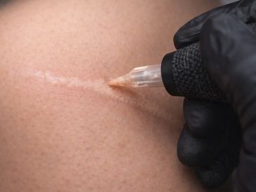 Scar camouflage tattoo procedure using a precision PMU rotary pen machine