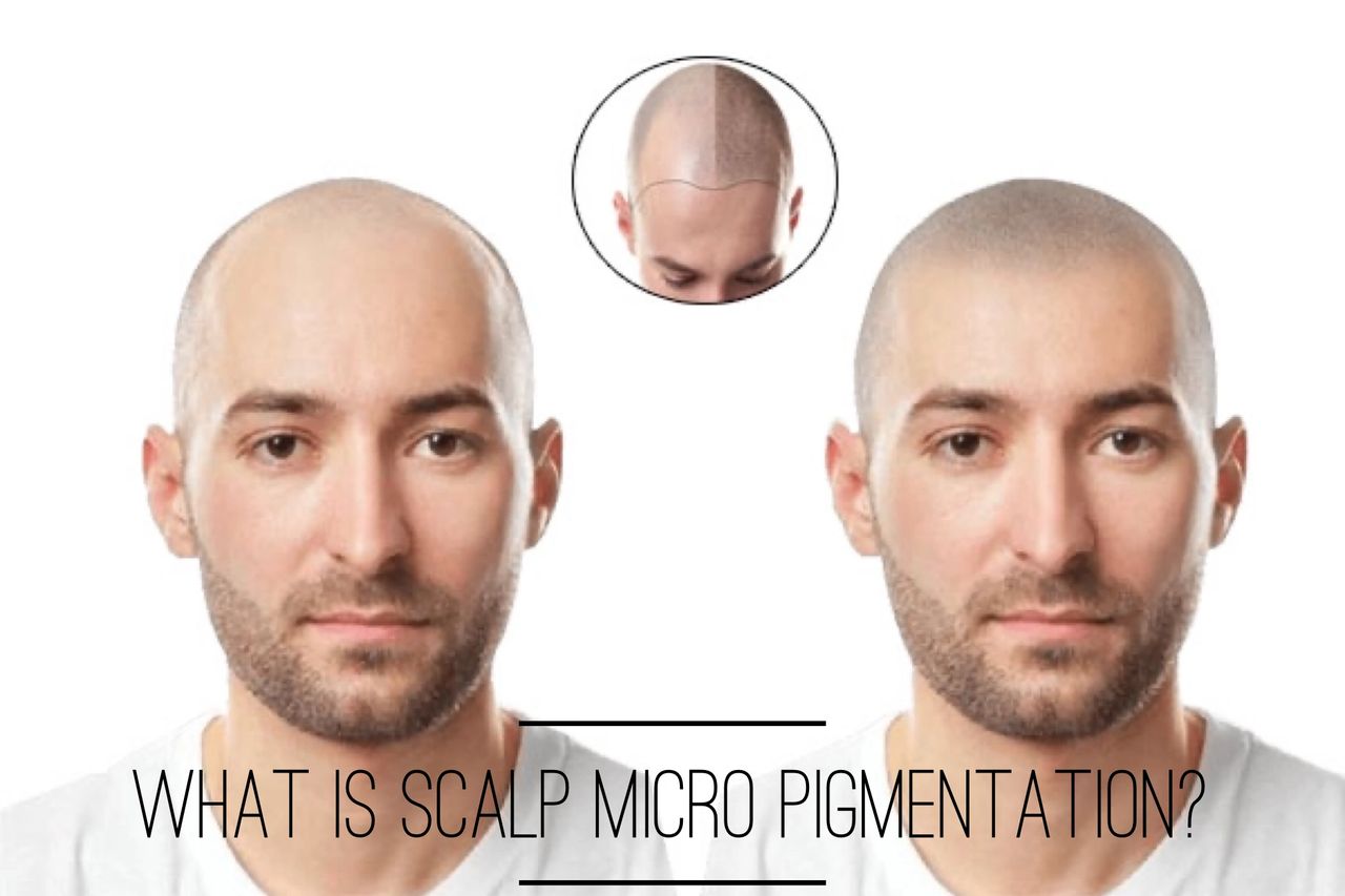 What is scalp micro pigmentation