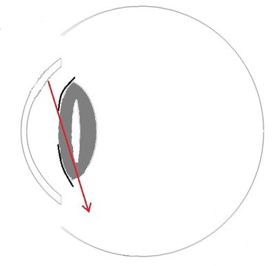 Ray relevant to negative dysphotopsia vignetted at edge of intraocular lens