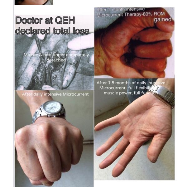 An industrial accident with 2 fingers completely detached.  100% rehabilitated after 6 weeks of Rx