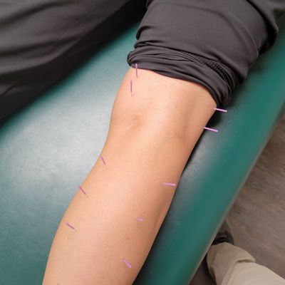 Intramuscular Stimulation / Dry Needling