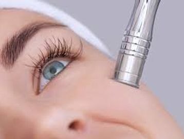 Microdermabrasion for gentle exfoliation and to remove impurities