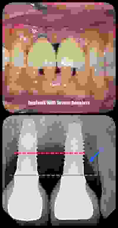 Severe boneloss around dental implants (peri-implantitis)