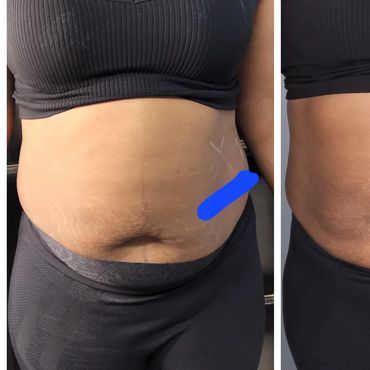 Before Cryoskin Slimming Treatment and 2weeks after first treatment 