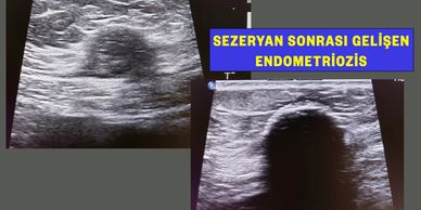 Endometriozis kriyoablasyon tedavisi
