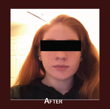 Photo of young teen after having acne treatment