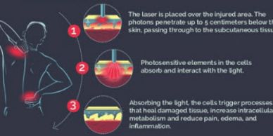 laser cold therapy erchonia