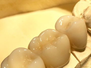 DENTAL BRIDGE