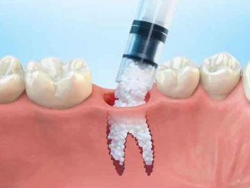 DENTAL BONE GRAFT