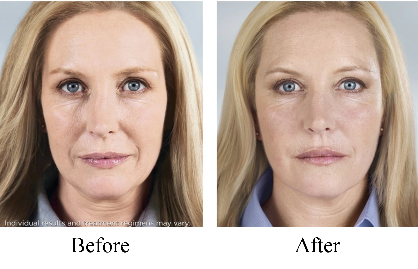 Sculptra vs PDO threads All about biostimulator