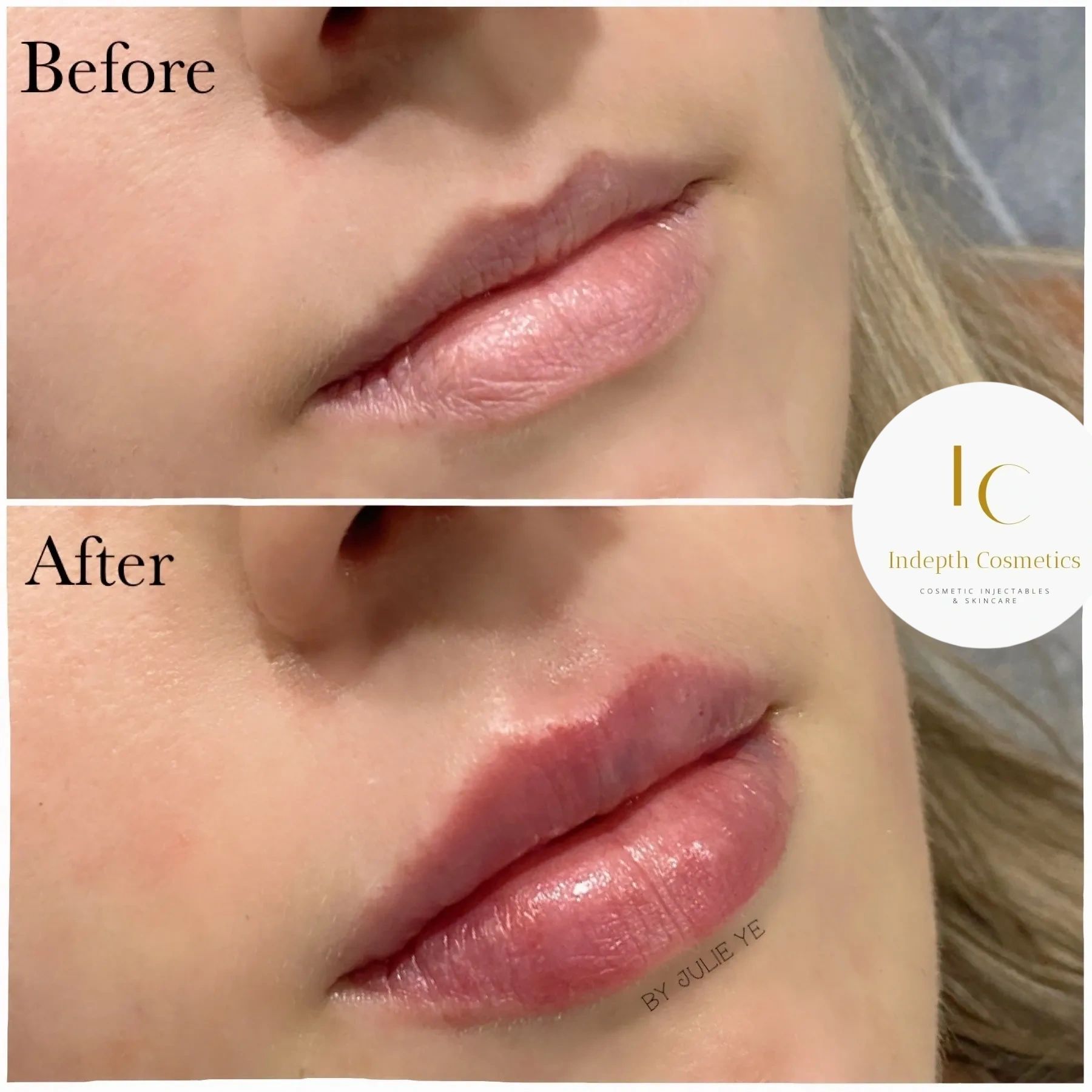 Best Lip Fillers Melbourne By Indepth Cosmetics