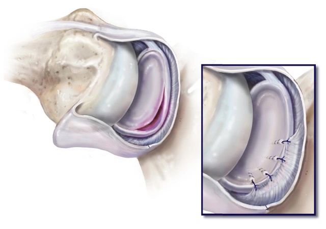 Bankart tear and repair