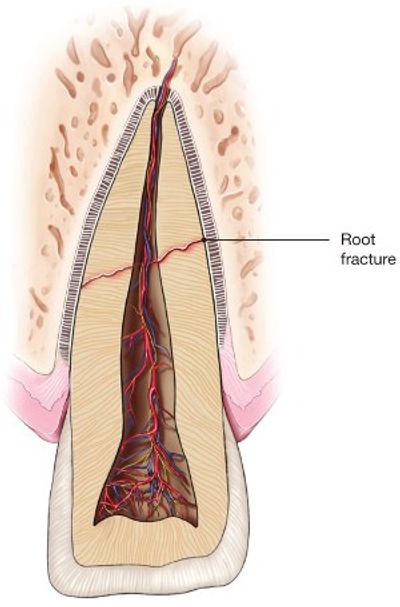 Dental Trauma | Boulder Endodontics PLLC