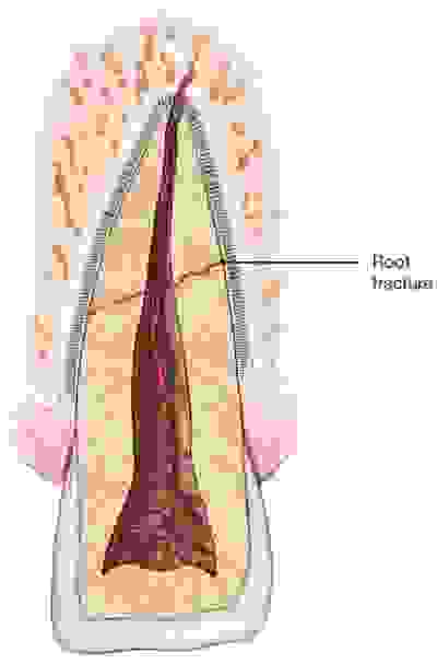 Dental Trauma | Boulder Endodontics PLLC