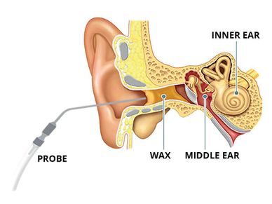 Microsuction Ear Wax Removal 