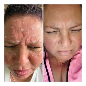 Wrinkle Treatment, Neurotoxin, Neuromodulators, Botox, Wrinkle reducer, Harrisburg PA