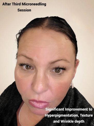 Results, reduced wrinkles, microneedling, Harrisburg PA, Med Spa