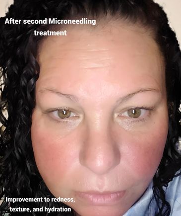 Skin improvement, microneedling facial, cytostem facial, Harrisburg PA, Med Spa