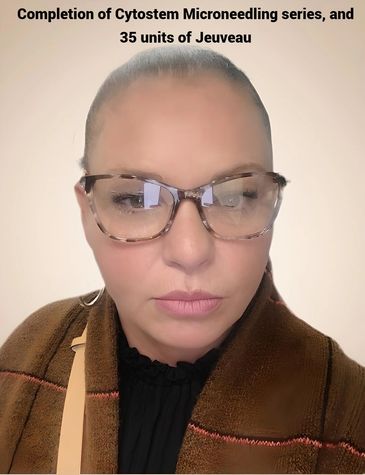 After, Jeuveau, Botox, Neurotoxin, Neuromodulator, Harrisburg PA, Med Spa