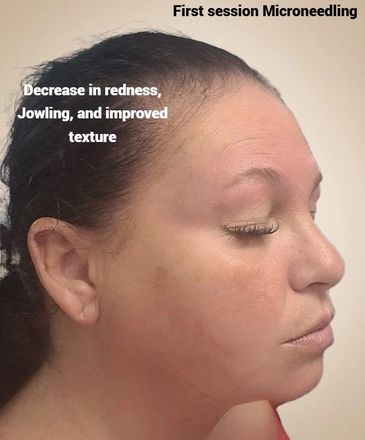 After picture, microneedling facial, Harrisburg PA, Med Spa, Microneedling results